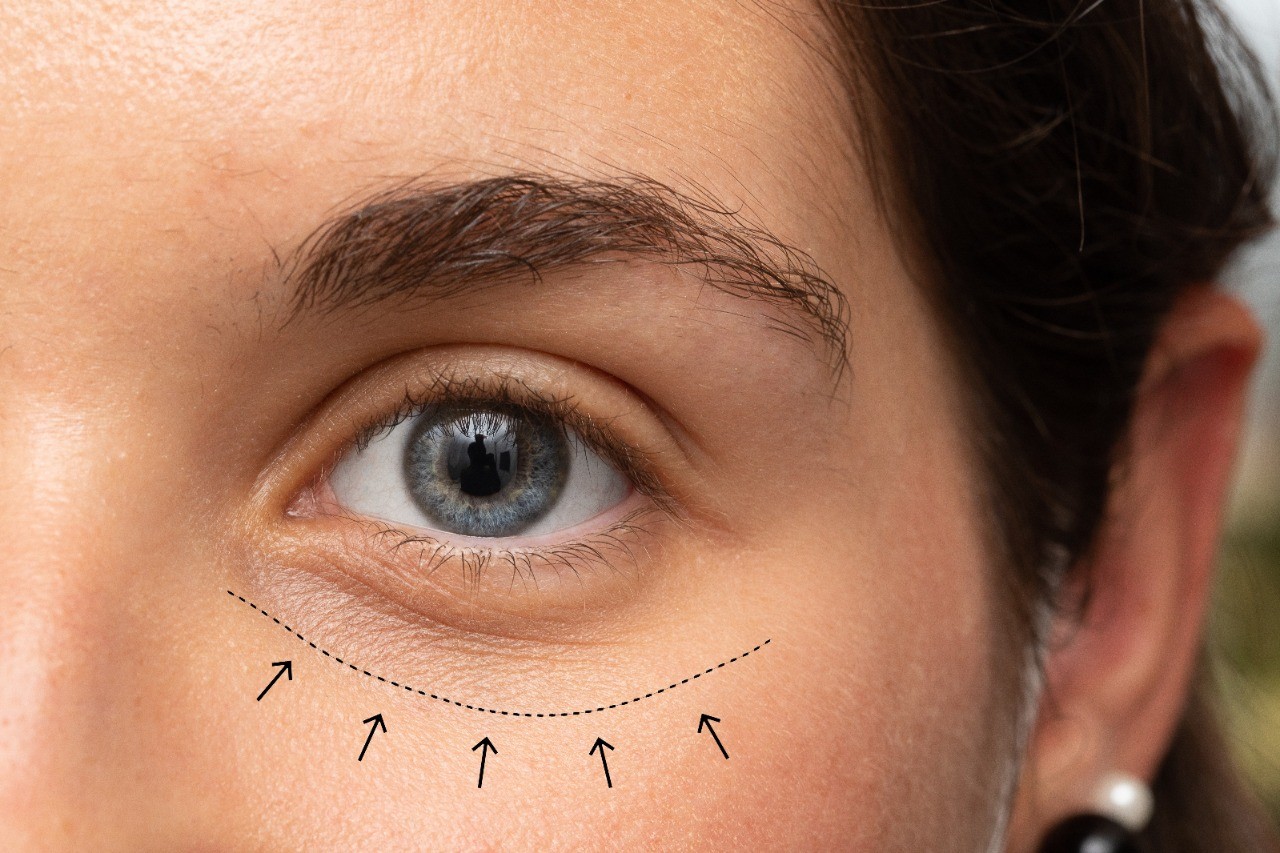 Enokii Blog - Types of dark circles & how to get rid of them.